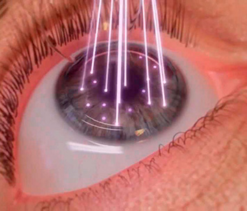 Tipos de cirurgias refrativas que usam laser.